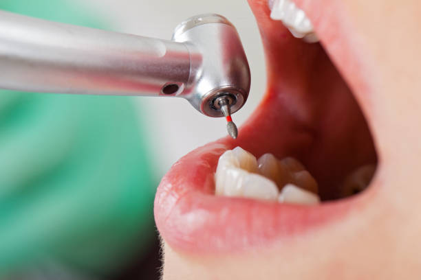 Best Emergency Dental Surgery in San Leandro, CA